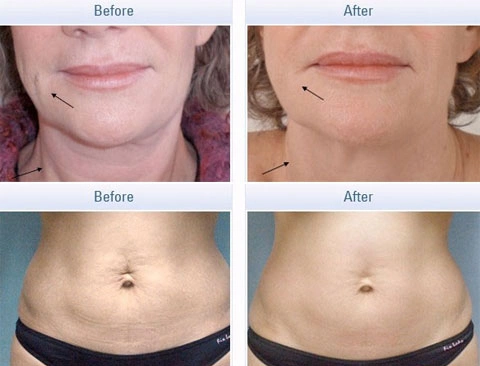 Trước và sau 4 lần điều trị