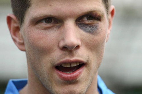 Huntelaar với vết thâm đen bí ẩn ở bên mắt trái. Huntelaar với vết thâm đen bí ẩn ở bên mắt trái.