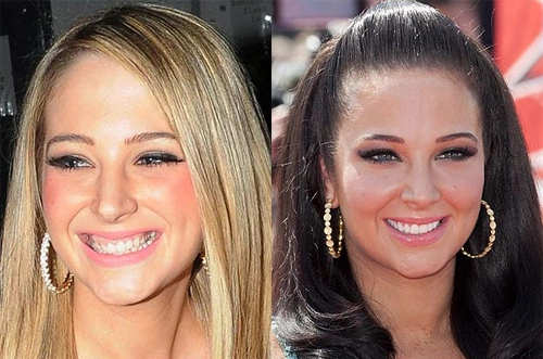 Hàm răng của ca sĩ Tulisa, bạn gái hậu vệ Danny Simpson cũng không được đẹp trước khi nổi tiếng. Hàm răng của ca sĩ Tulisa, bạn gái hậu vệ Danny Simpson cũng không được đẹp trước khi nổi tiếng.
