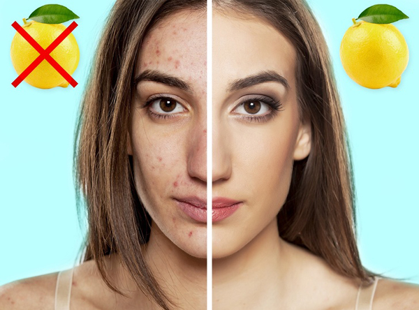 Làm giảm sẹo mụn Chanh rất giàu vitamin C và axit citric, giúp điều trị mụn cám và sẹo mụn hiệu quả. Vitamin C tăng cường sản xuất collagen và giữ cho làn da mịn màng và khuyến khích sự hình thành các tế bào da mới. Nhờ đặc tính tẩy trắng tự nhiên mà nước chanh có thể làm sáng các vết thâm cho mụn để lại. Trộn nước cốt chanh với dầu dừa nguyên chất, thoa lên vùng da có sẹo mụn sẽ giúp làm mờ sẹo.
