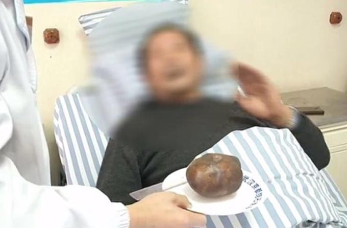 Bác sĩ cho ông Zhou xem viên sỏi lớn mà họ vừa lấy ra từ bàng quang ông. Ảnh: AsiaWire.