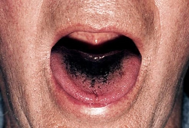 Ảnh: Webmd