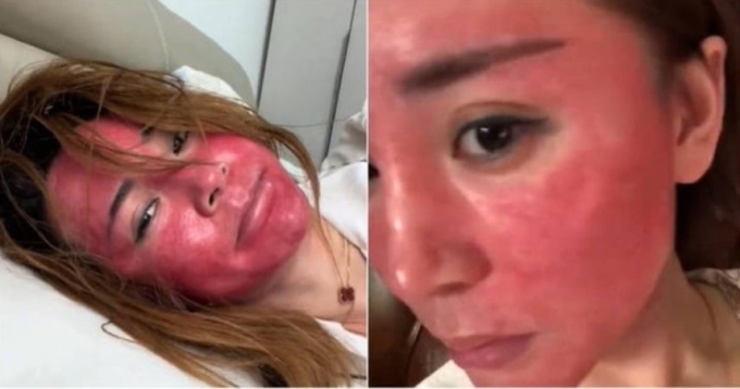 Người phụ nữ gây sốc với khuôn mặt biến dạng do thói quen không làm sạch da đúng cách.