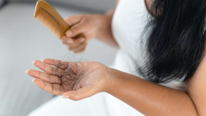 Ngày càng nhiều cô gái ở Hàn Quốc bị rụng tóc bất thường. Ảnh minh họa: UCLA Health